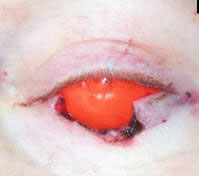 Intraoperative photo with large defect in left lower eyelid to completely remove cancer